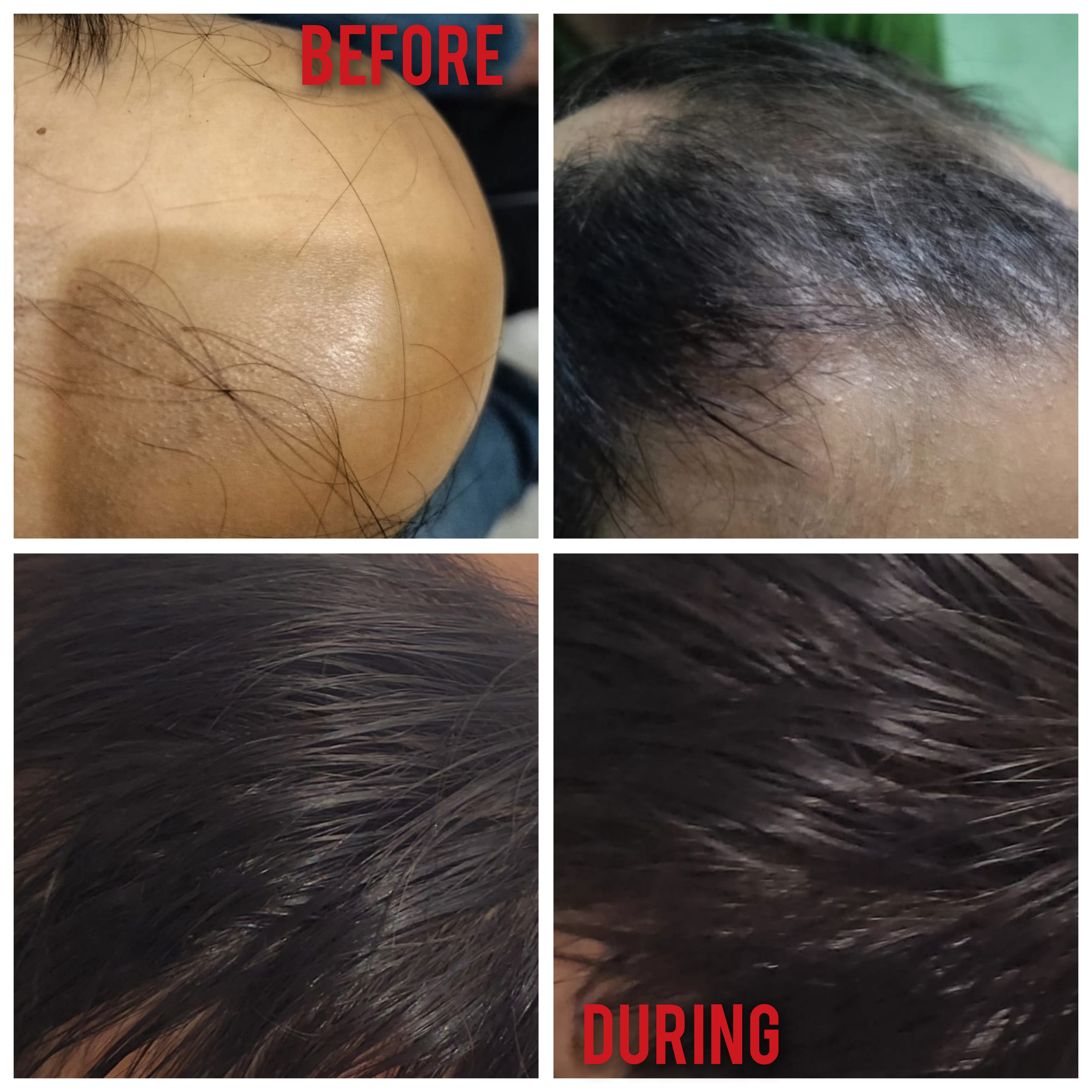 AUTO-IMMUNE ALOPECIA AREATA