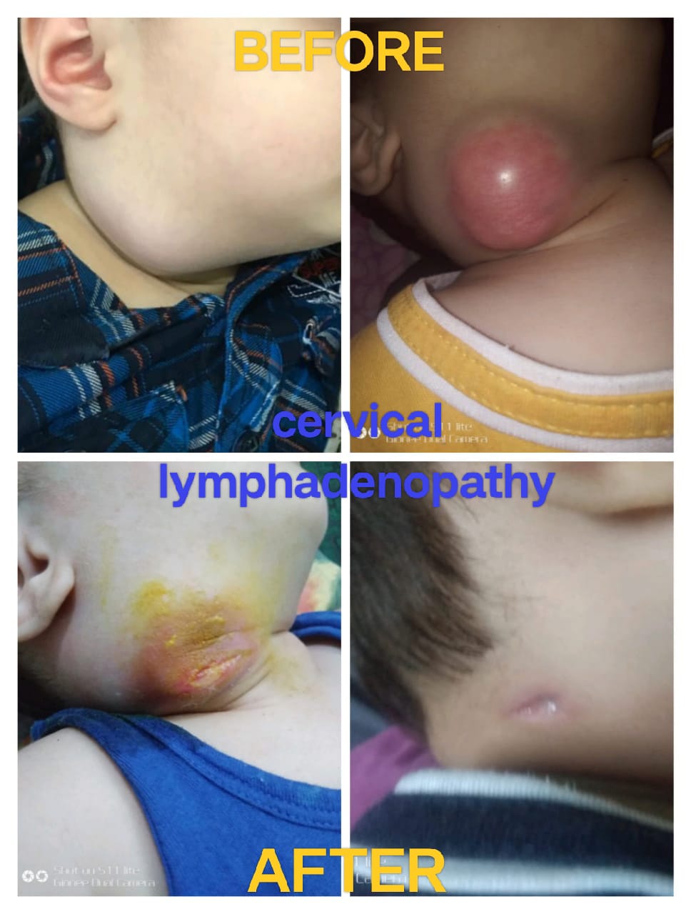 WONDERFUL RESULT IN HOMOEOPATHY FOR CERVICAL LYMPHADENOPATHY 