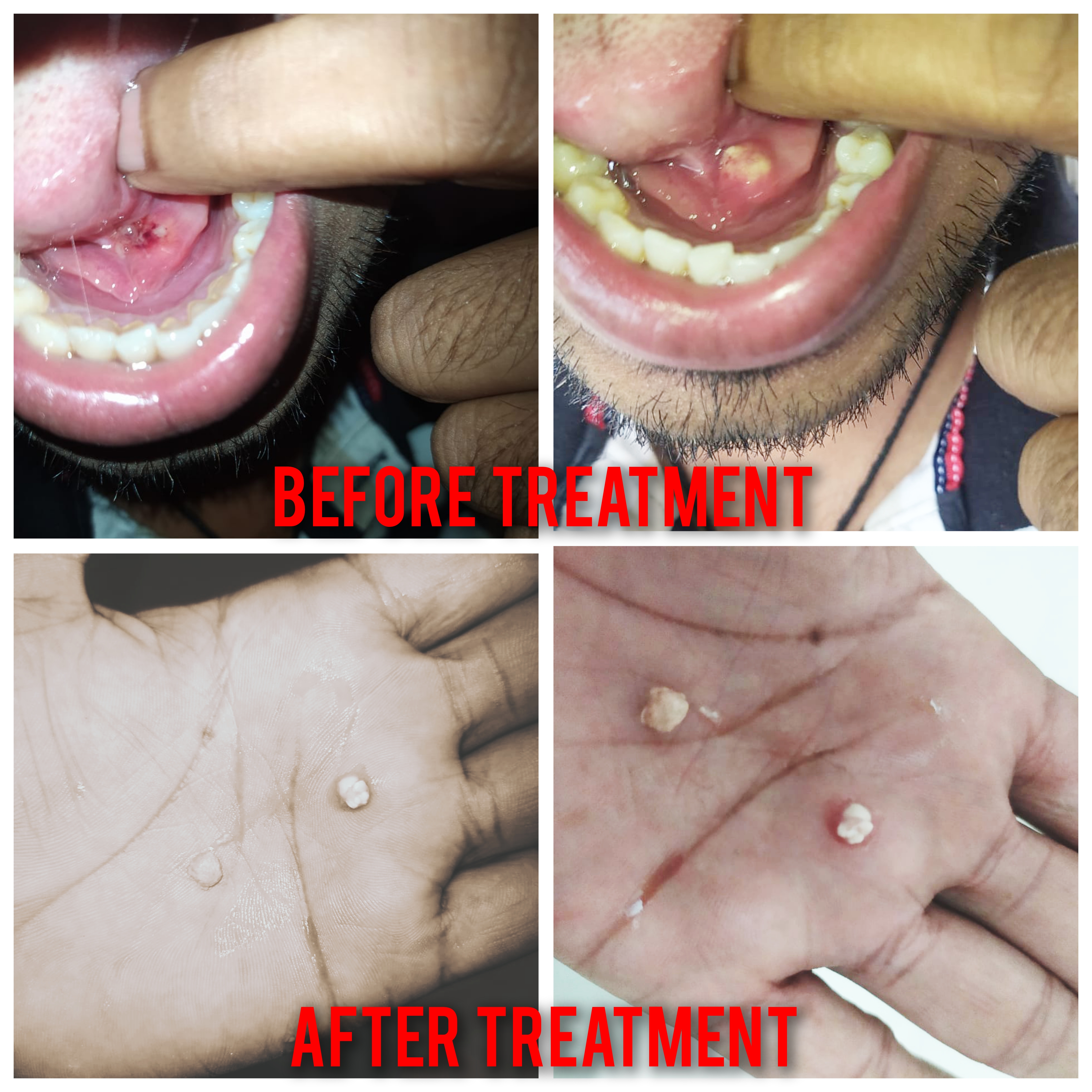 SALIVARY GLAND DUCT STONE(Sialolithiasis )CURED THROUGH HOMOEOPATHIC TREATMENT 